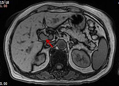 Inflammatory Myofibroblastic Tumor of the Hilar Bile Duct: A Case Report and Literature Review